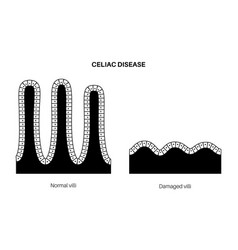 Celiac disease inflammation Royalty Free Vector Image