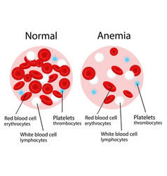 Iron Deficiency Anaemia Vector Images (75)