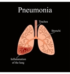 Pneumonia The anatomical structure of the human Vector Image