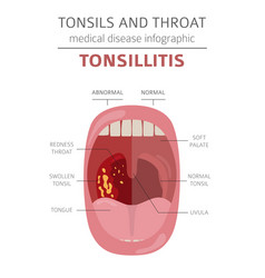 Tonsils and throat diseases tonsillitis symptoms Vector Image