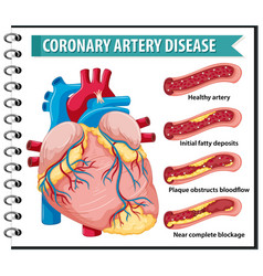 Coronary artery disease for health education Vector Image