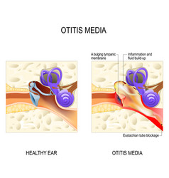 Gingivitis and periodontitis Royalty Free Vector Image