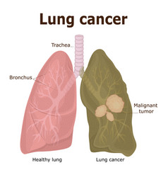 Pneumothorax hemothorax and hemopneumothorax Vector Image