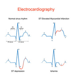 Ecg of st elevation myocardial infarction stemi Vector Image