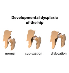 Different types of hip dislocation Royalty Free Vector Image