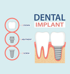 Teeth maquette structural elements of dental Vector Image