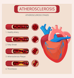 Atherosclerosis stages normal functions Royalty Free Vector