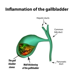 Biliary Dyskinesia Vector Images (25)