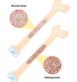 osteoporosis vector image vector image