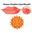 herpes simplex virus lipsmouth vector image vector image