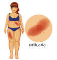 woman with urticaria problem vector image vector image