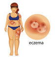 diagram showing woman with eczema vector image vector image