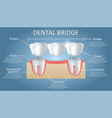 dental bridge concept educational poster vector image vector image
