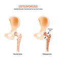 osteoporosis normal hip joint and bone with low vector image vector image