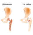 osteoporosis that caused of hip fracture vector image vector image