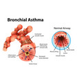 Asthma inflamed bronchial tube Royalty Free Vector Image