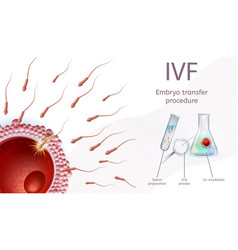In Vitro Fertilization Embryo Transfer Procedure Vector Image