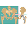 Hip osteoarthritis poster Royalty Free Vector Image