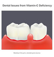 dental issues from vitamin c deficiency about vector image vector image