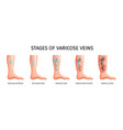 stages of varicose veins vector image
